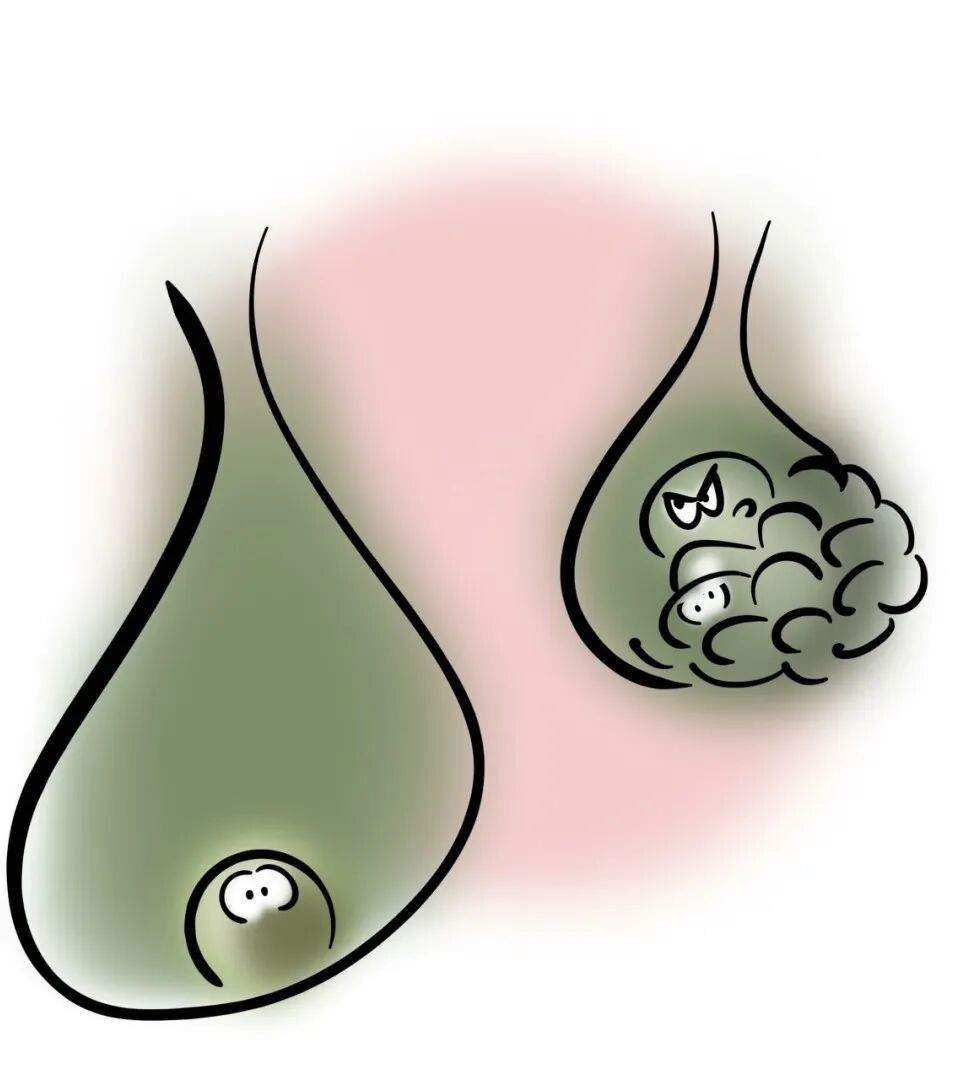 醫(yī)生提醒：膽石癥偏愛這六類人！做好這些事，遠離膽石癥→