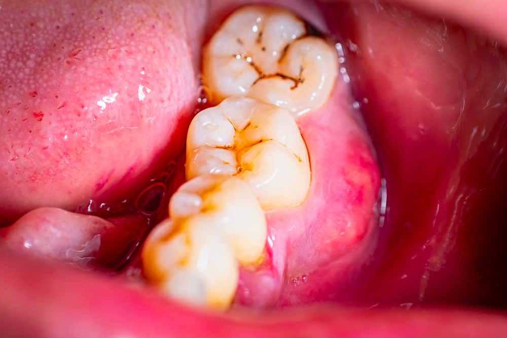 照鏡子就能發(fā)現(xiàn)的一種常見病，越早治越省錢！